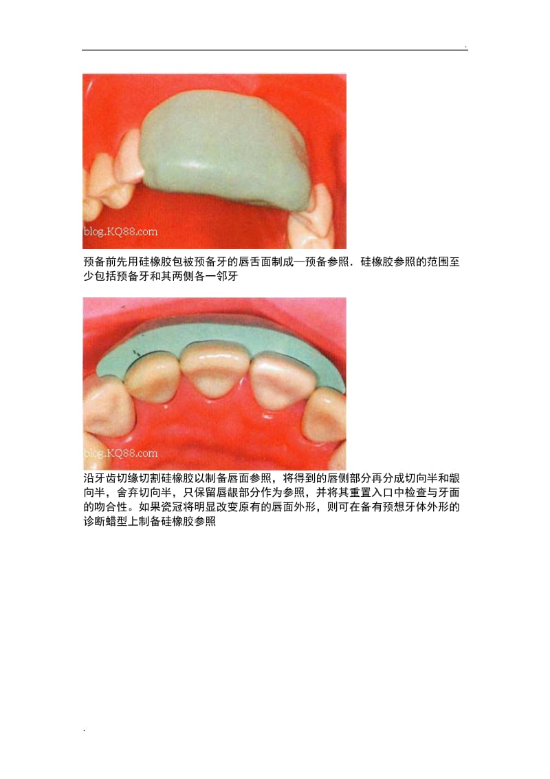全瓷牙备牙方法图例_第2页