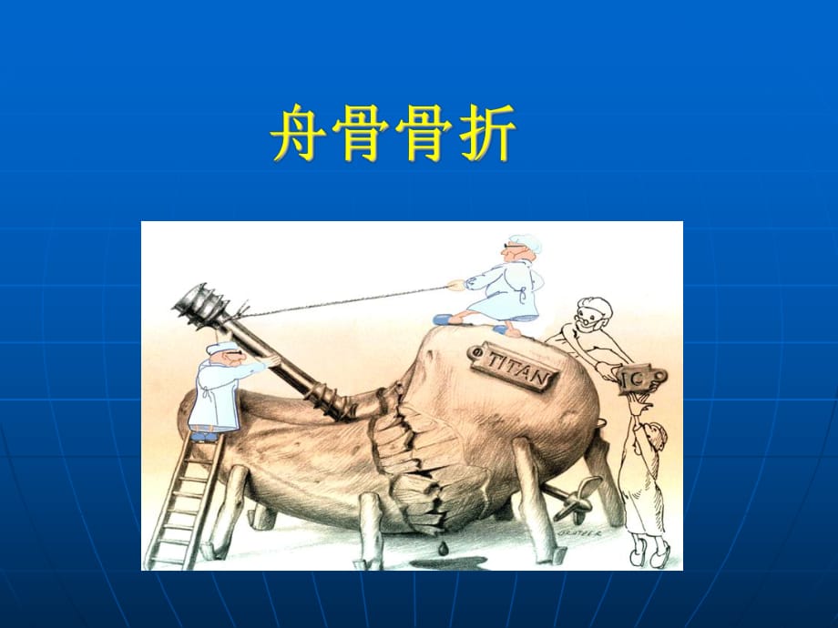 《舟骨骨折》.ppt_第1页