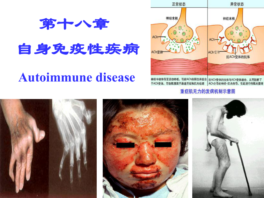 自身免疫性疾病 PPT课件.ppt_第1页