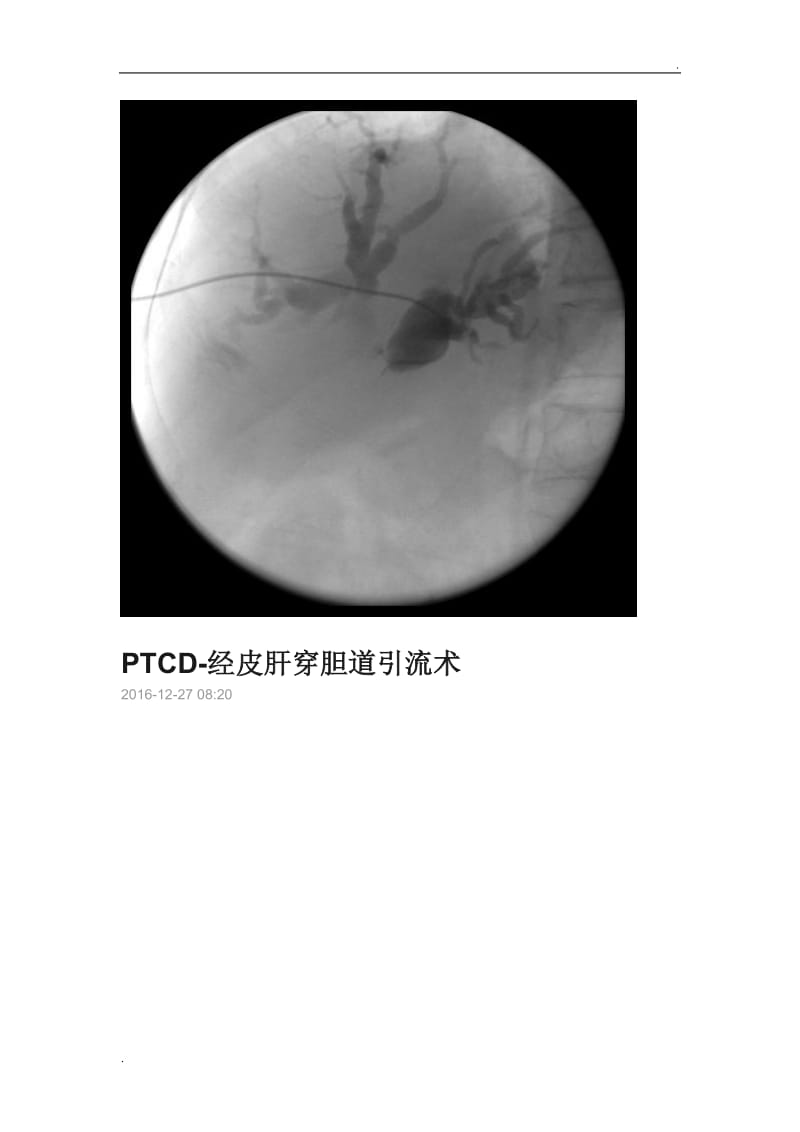 经皮穿刺肝胆管引流术_第1页