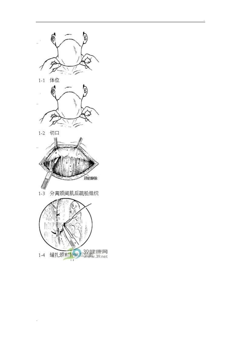 甲状腺次全切除术手术步骤详解_第3页