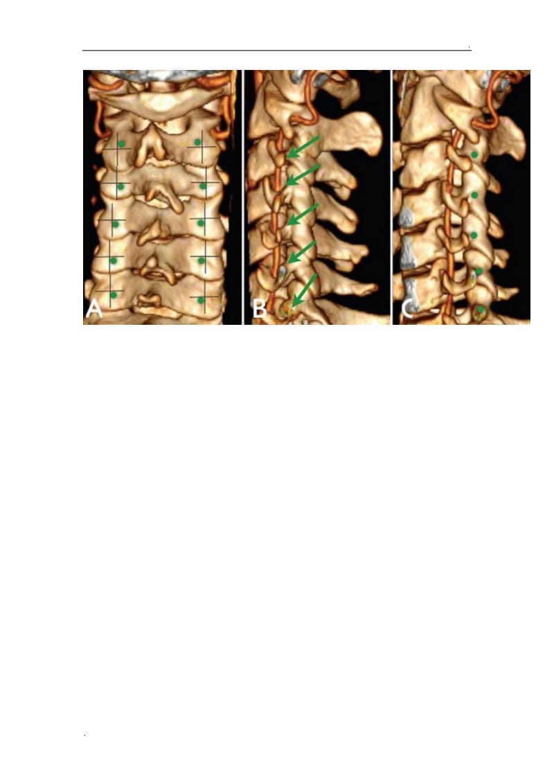 脊椎椎弓根钉进钉点的确定及手术技巧_第3页
