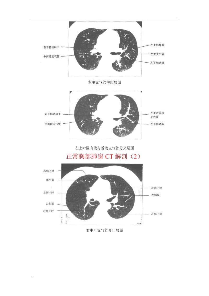 正常胸部CT(肺窗和纵隔窗)_第2页