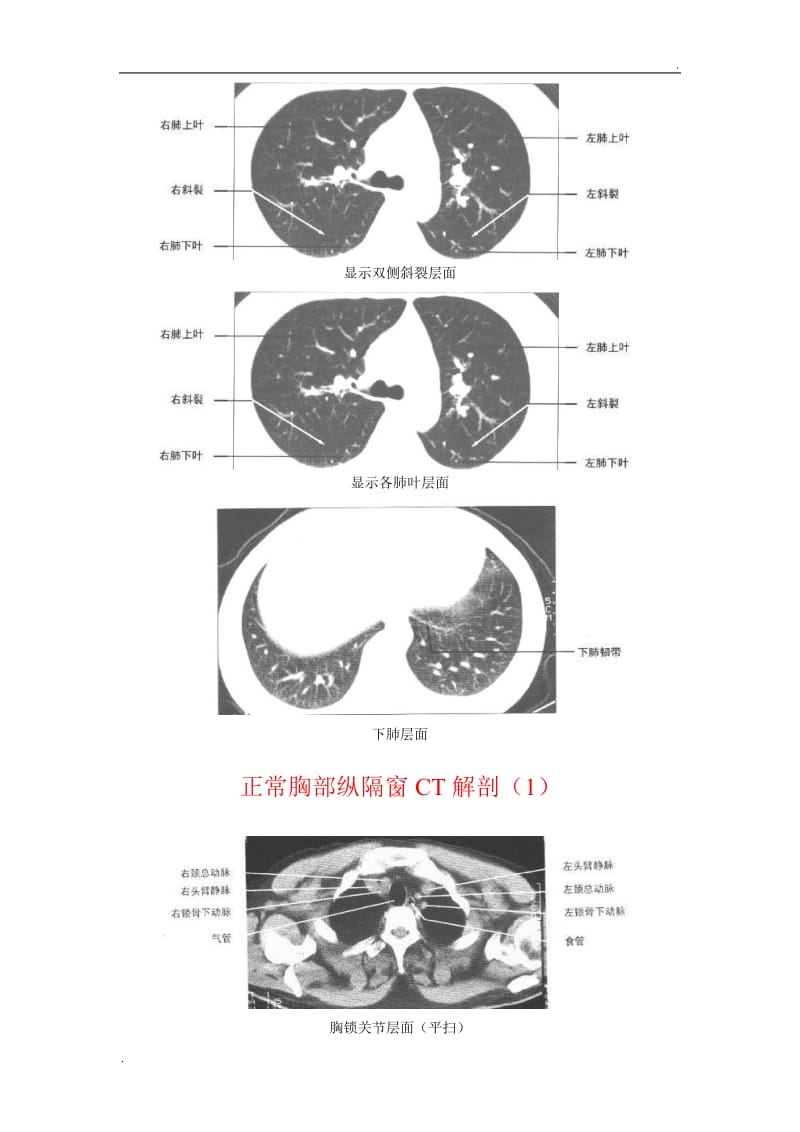 正常胸部CT(肺窗和纵隔窗)_第3页