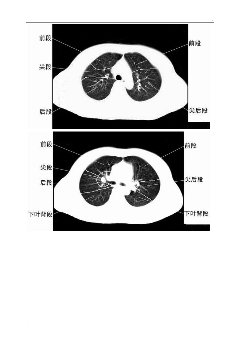 胸部CT肺段划分口诀_第2页