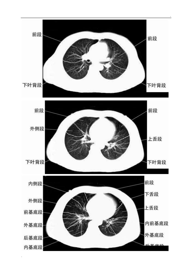 胸部CT肺段划分口诀_第3页