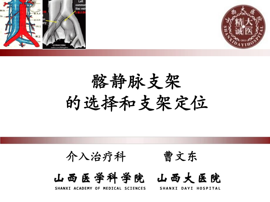 髂靜脈支架的選擇和支架定位_第1頁(yè)