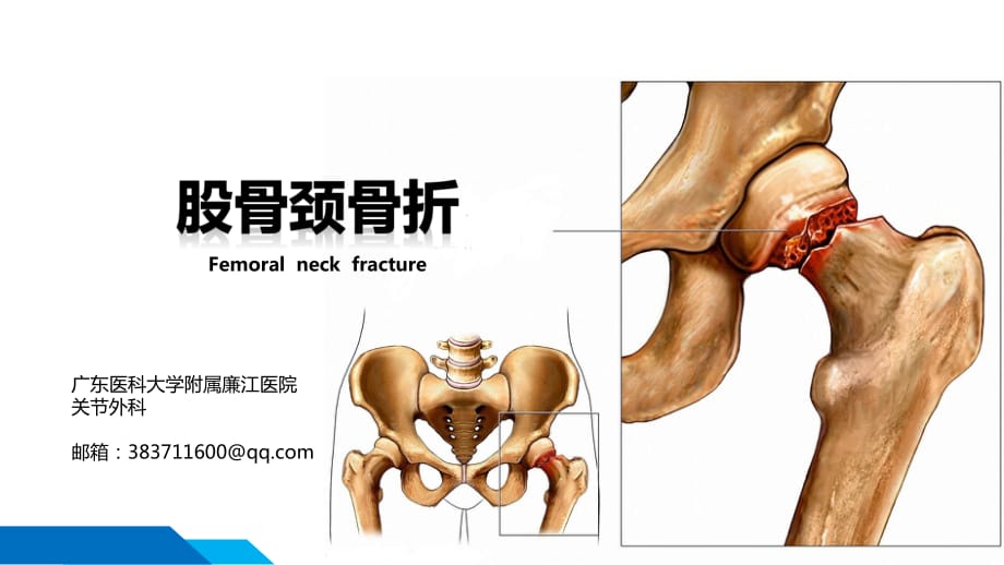 股骨頸骨折 PPT課件.ppt_第1頁(yè)