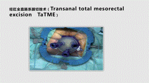 TaTME直肠癌手术的新突破PPT课件
