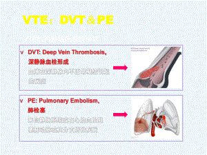 下肢深靜脈血栓形成的診斷和治療ppt課件
