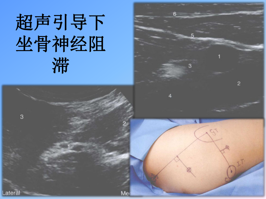 坐骨神經(jīng)阻滯xjq-_第1頁(yè)