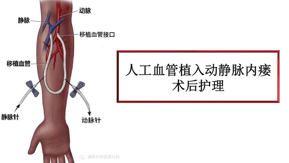 人工血管动静脉内瘘术后护理课件_第1页