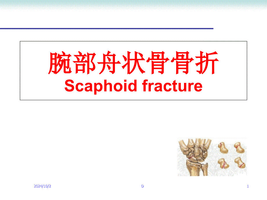 腕部舟状骨骨折医学课件_第1页