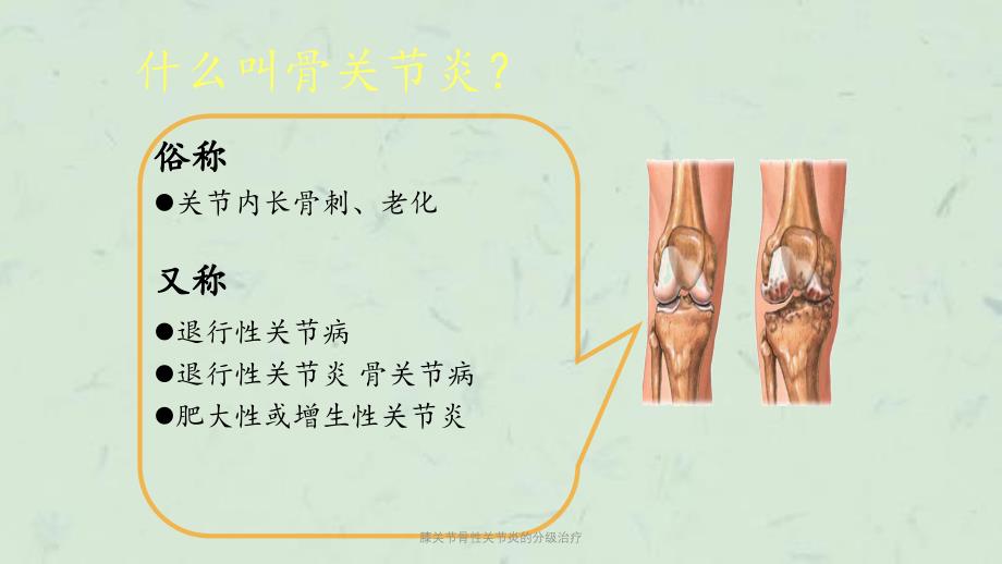 膝关节骨性关节炎的分级治疗课件_第1页