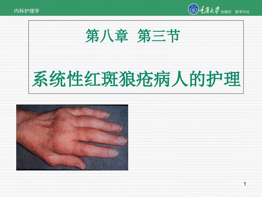 内科护理学第八章第三节系统性红斑狼疮的护理课件_第1页