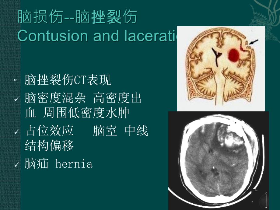 常见神经系统疾病影像学表现讲解ppt课件_第1页