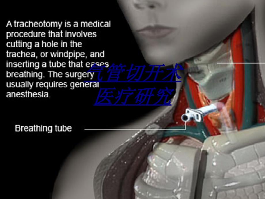 气管切开术医疗研究讲义课件_第1页