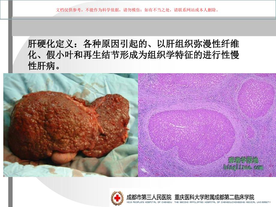 内科学肝硬化课件_第1页