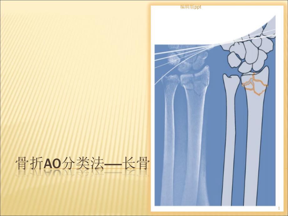 骨折AO分型课件_第1页