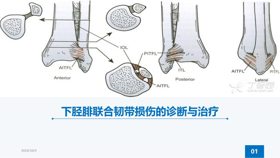 下胫腓联合韧带损伤ppt参考课件_第1页