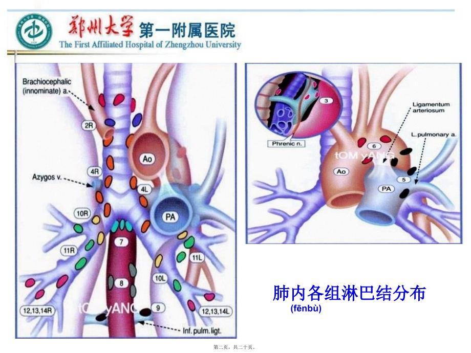 2022年医学专题—VATS左侧肺癌根治术中的淋巴结清扫---胸外科_第1页