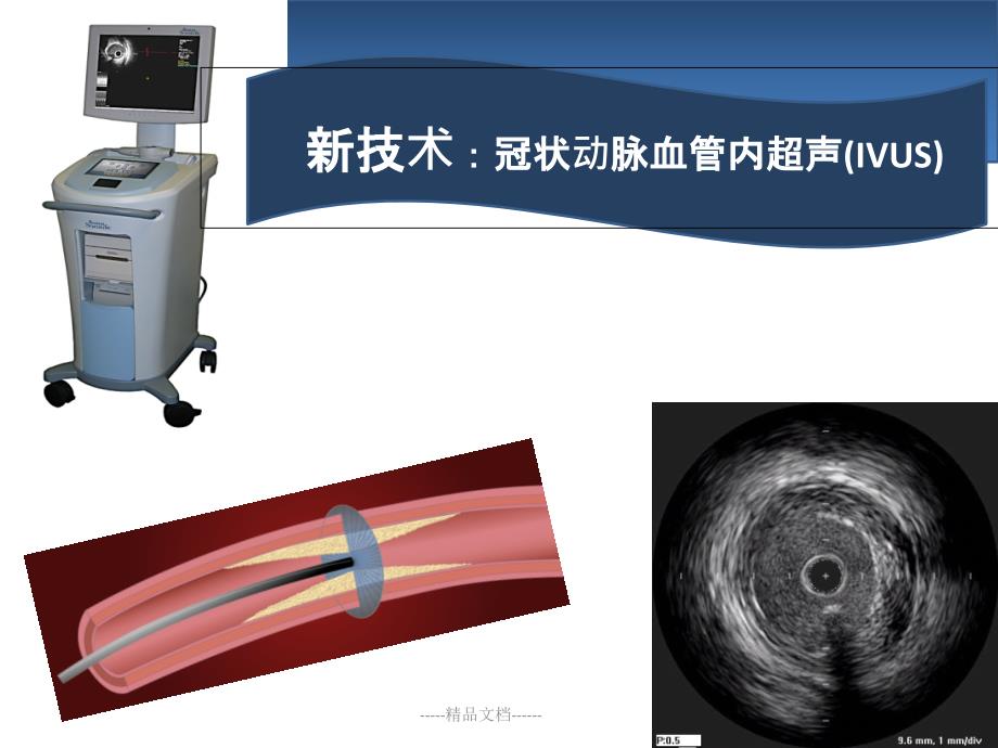 血管内超声IVUS简介课件_第1页