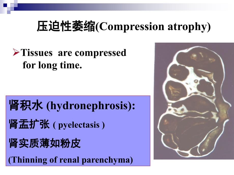 压迫性萎缩(Compression atrophy)_第1页