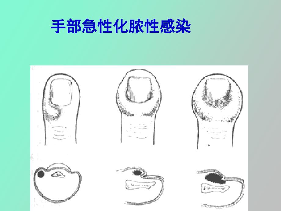 手部急性化脓性感染_第1页