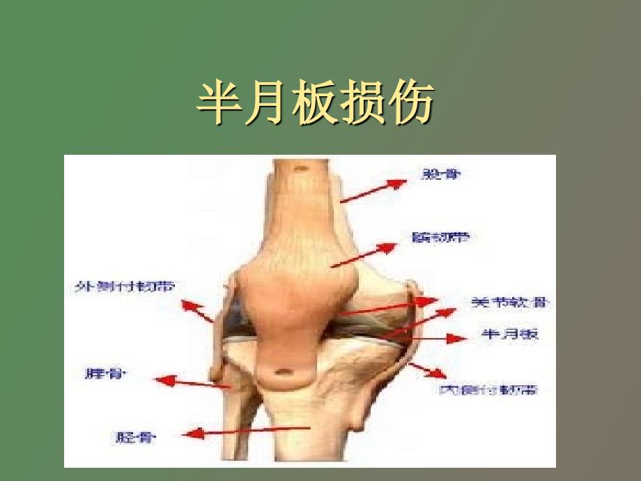 半月板损伤影像表现_第1页