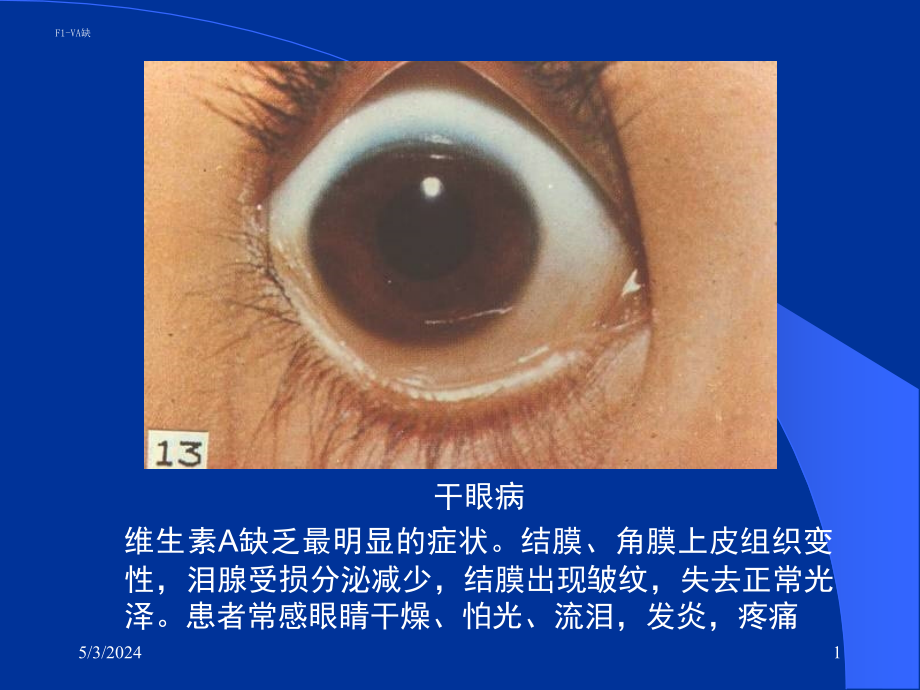 干眼病维生素A缺乏最明显的症状结膜、角膜上皮组织变性,泪腺_第1页