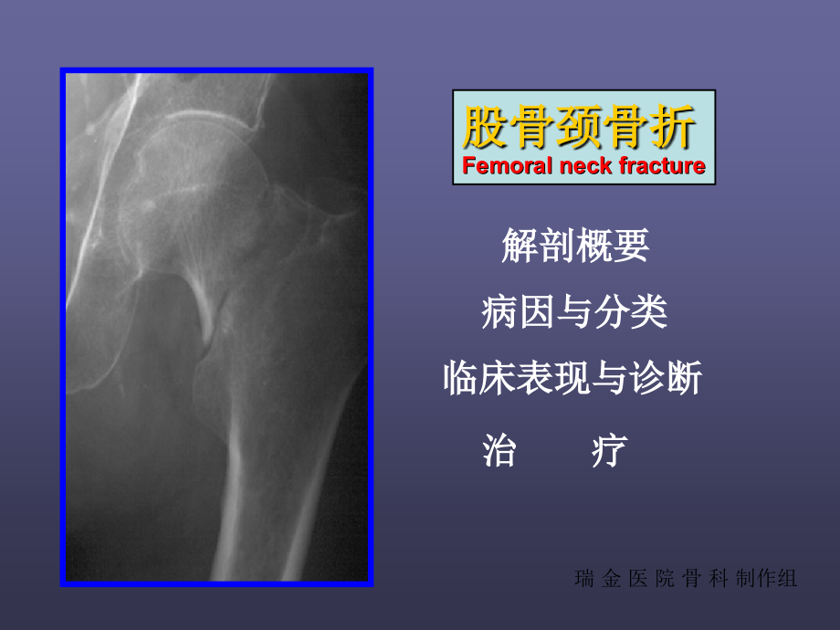 股骨頸骨折_第1頁