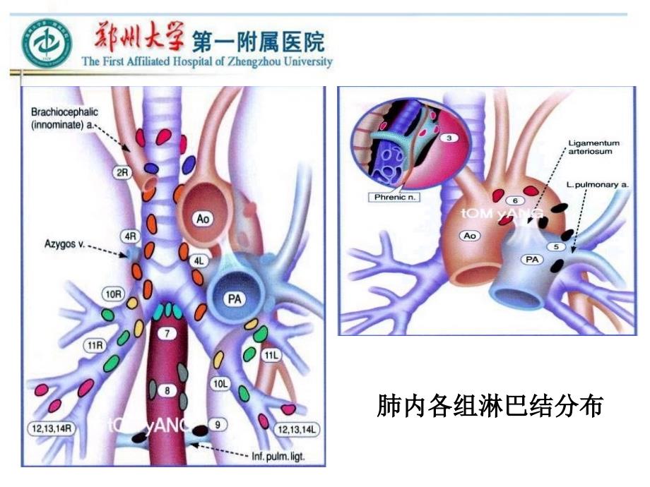 VATS左侧肺癌根治术中的淋巴结清扫---胸外科课件_第1页