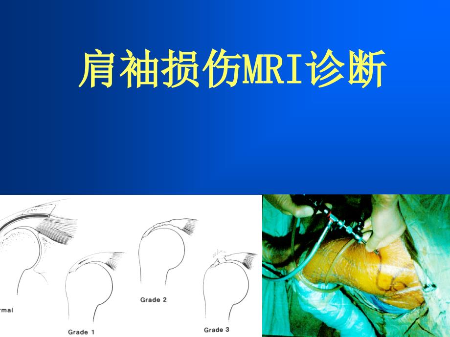 【关节外科】课件肩袖损伤MRI诊断_第1页