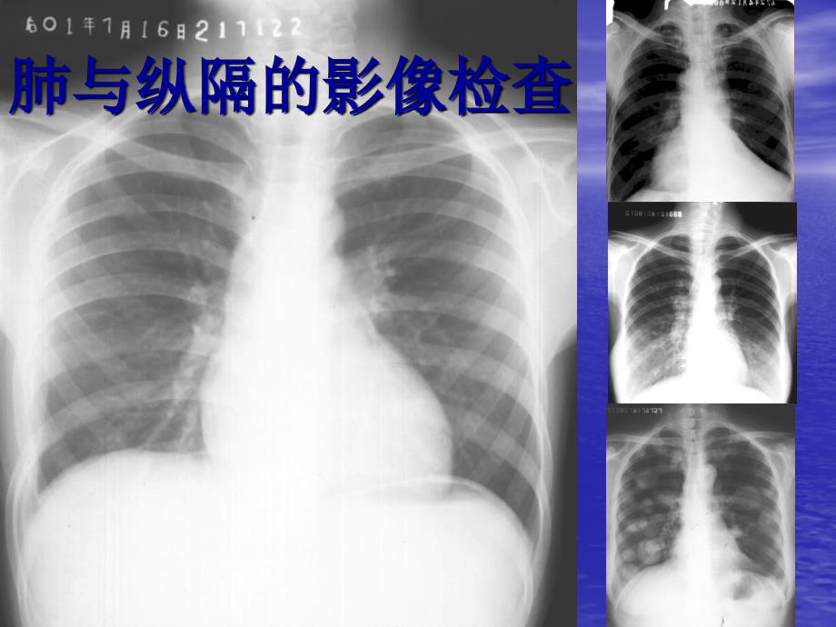 学看胸部CT_第1页