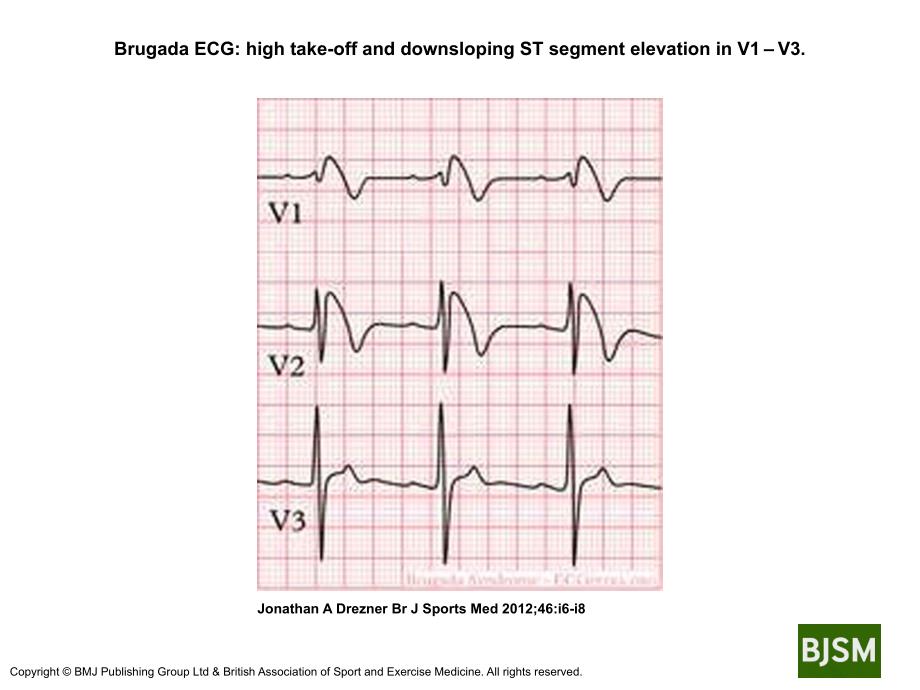 BrugadaECGhightake-offanddownslopingSTsegment_第1页