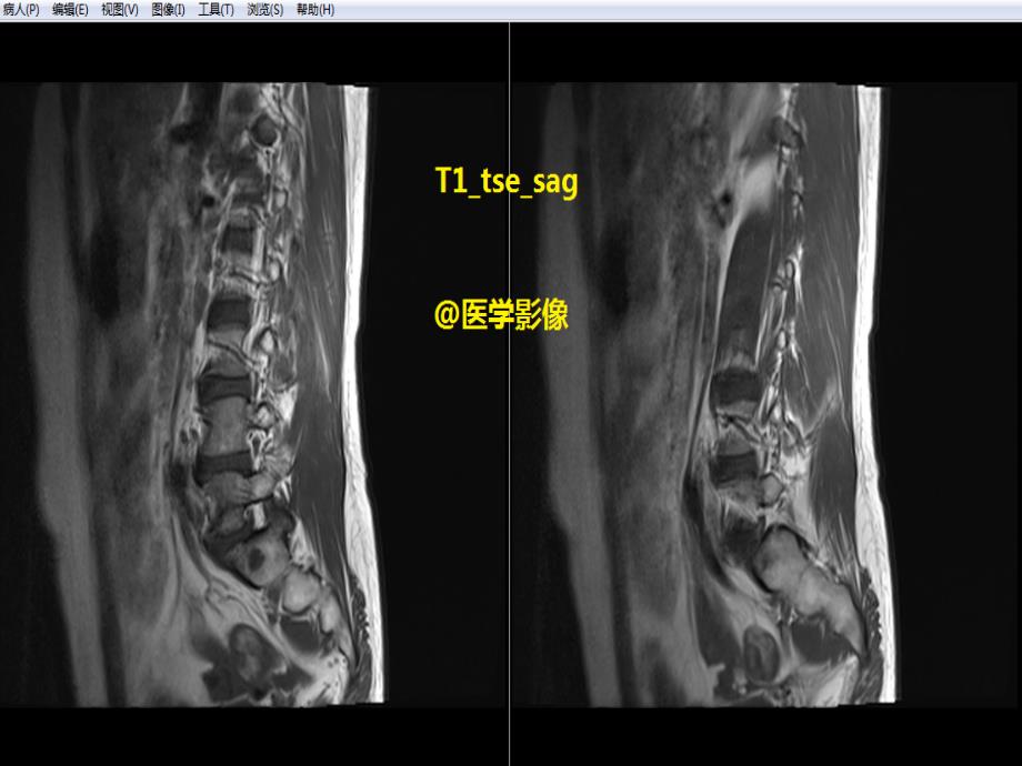 腰椎体血管瘤MRI表现_第1页