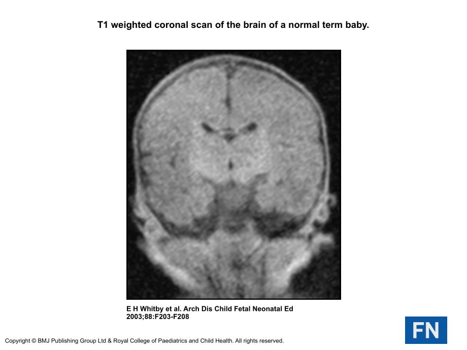 T1weightedcoronalscanofthebrainofanormaltermbaby_第1页