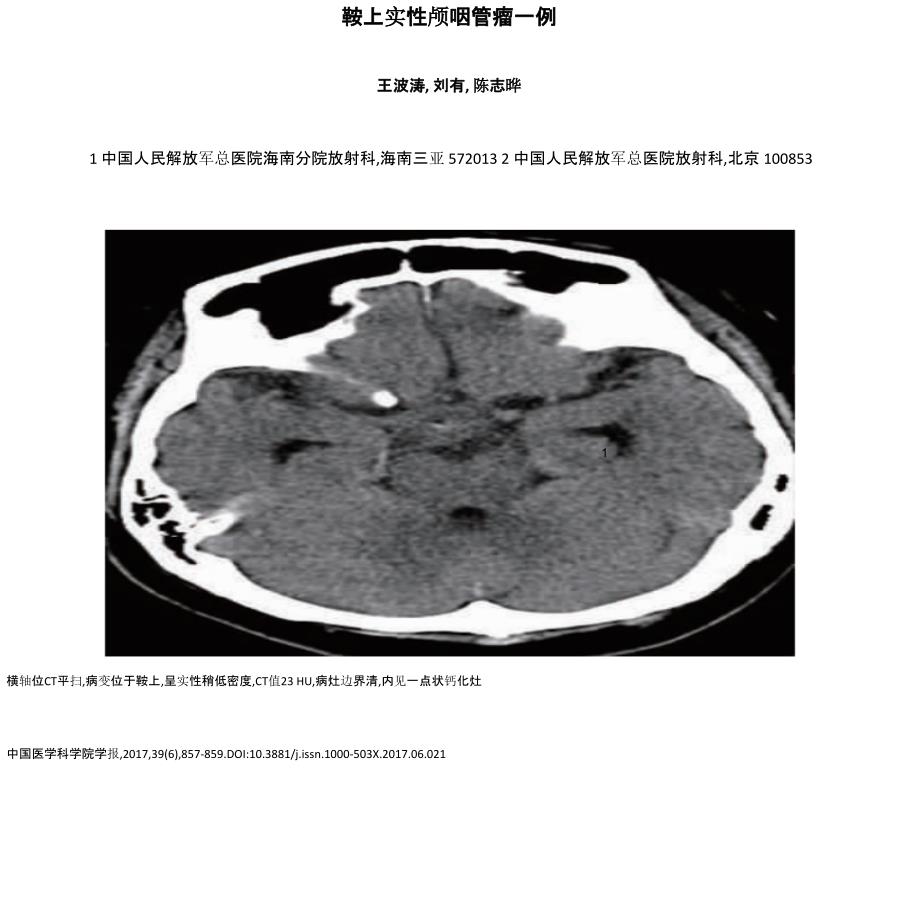 鞍上实性颅咽管瘤一例_第1页