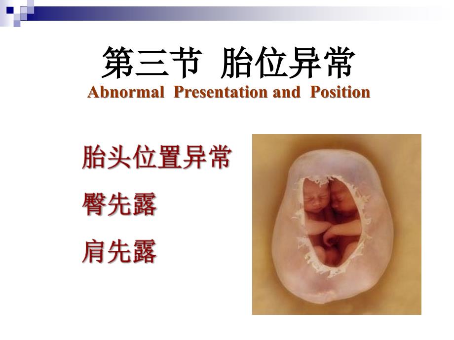 胎位异常教案PPT_第1页