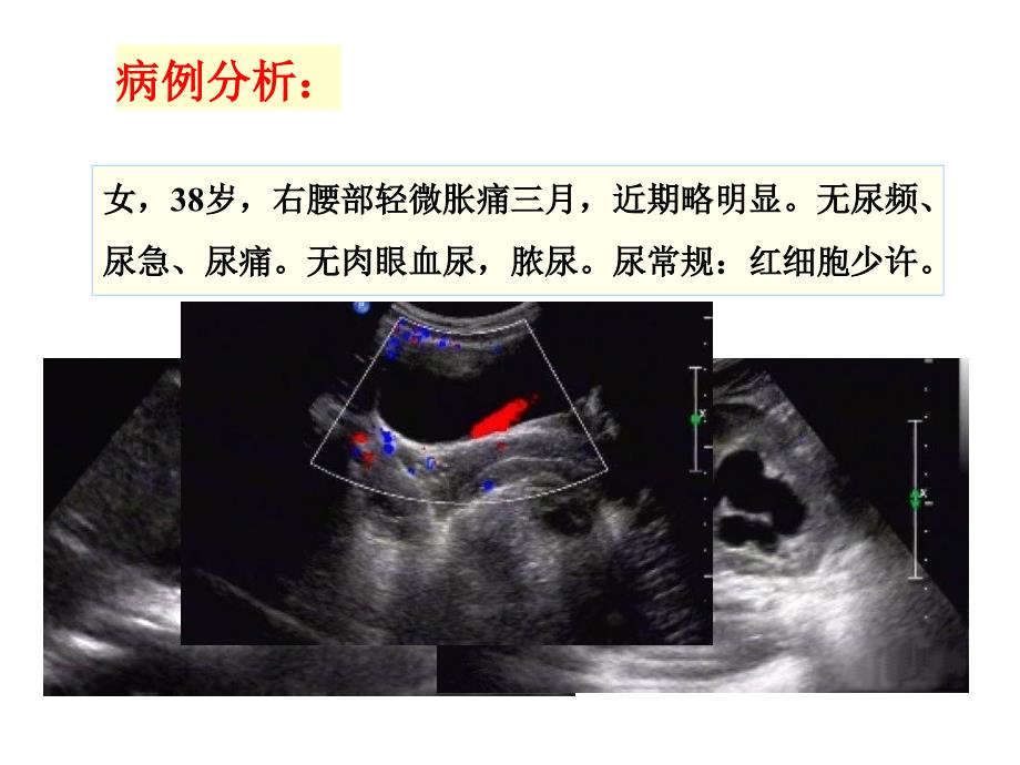 肾脏疾病的超声诊断课件_第1页