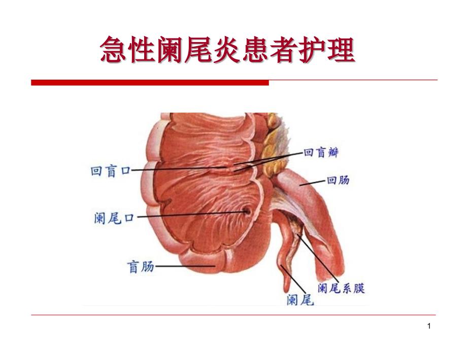 急性阑尾炎病人的护理演示课件_第1页