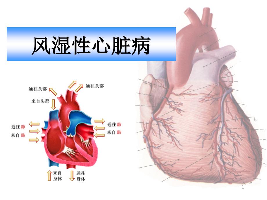 风湿性心脏病影像诊断与鉴别学习ppt课件_第1页