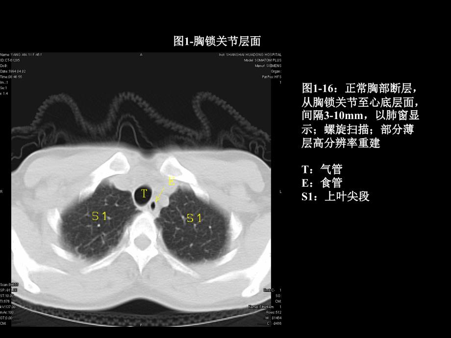 天津医科大学胸部ct解剖及典型病例ct征象 ppt课件_第1页