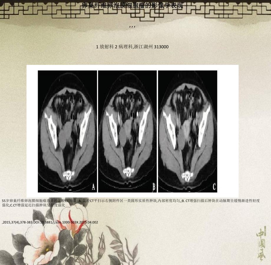 卵巢纤维卵泡膜细胞瘤的影像学表现_第1页