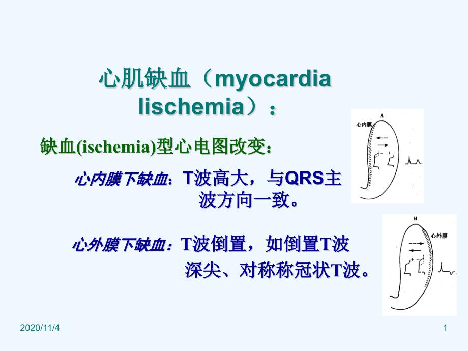 心肌缺血心电图_第1页