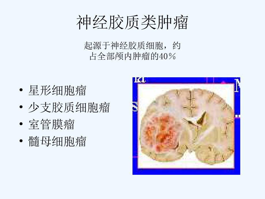 星形细胞瘤CT诊断_第1页