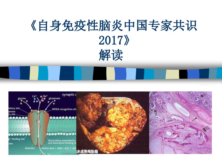 2017年自身免疫性脑炎中国专家共识解读(精华版)课件_第1页