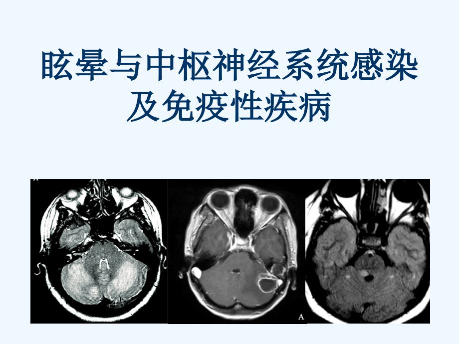 眩晕与中枢神经系统感染及免疫性疾病_第1页