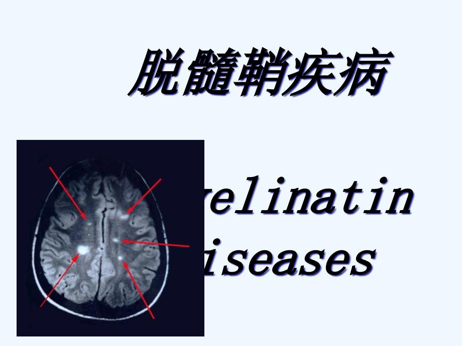 神经病学翁多发性硬化_第1页