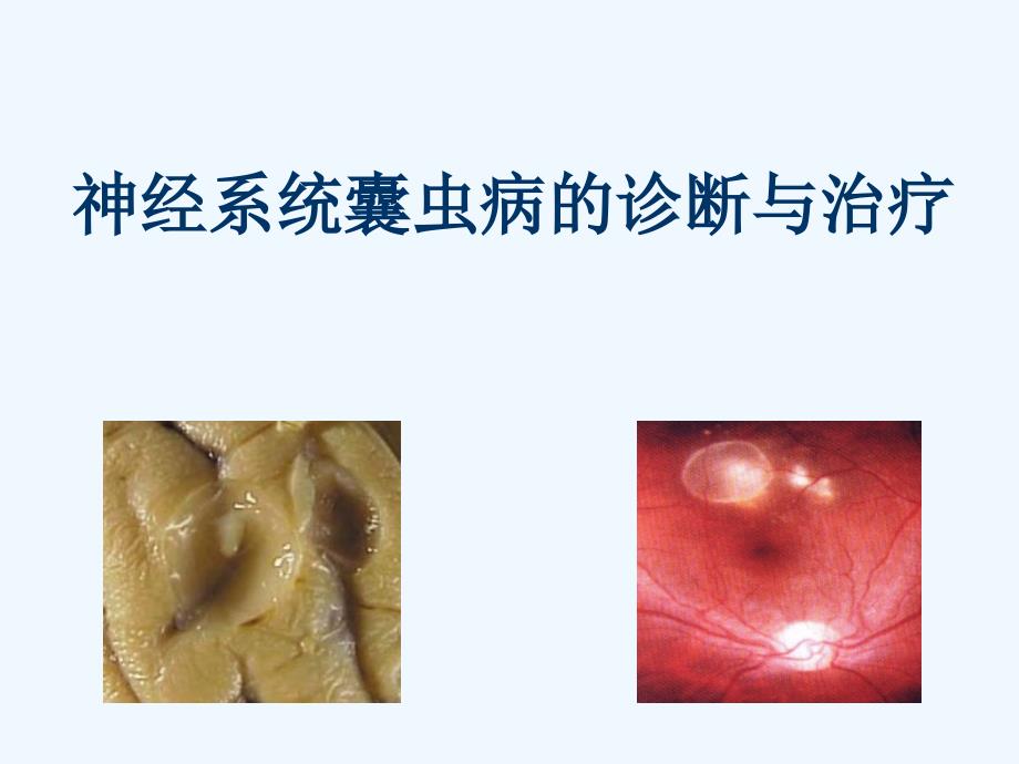 神经系统囊虫病诊断和治疗_第1页